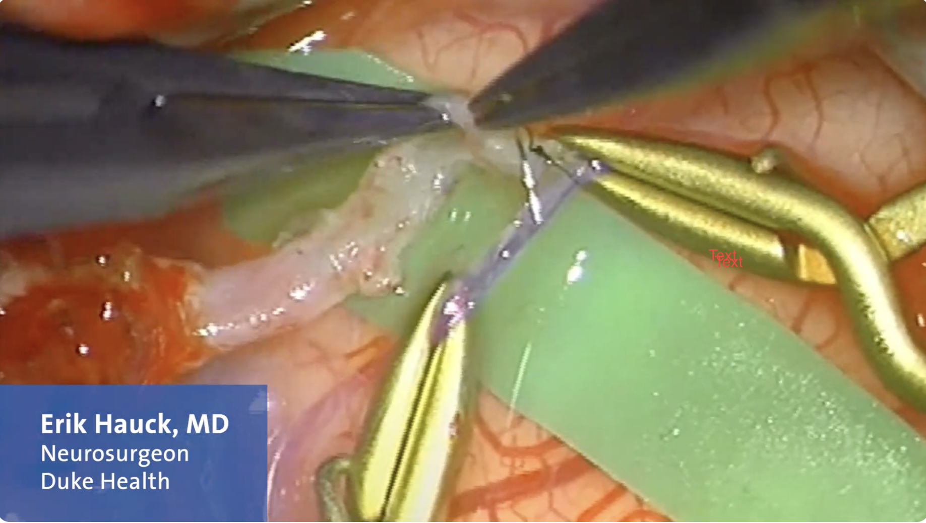 moyamoya surgical video