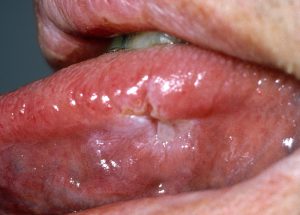 gonorrhea on tongue