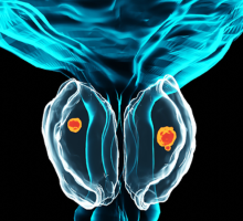 Illustration of prostate cancer