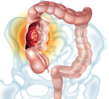 Illustration of cancer in the colon