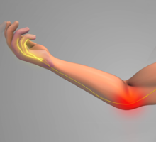 Illustration of nerve pain in the arm