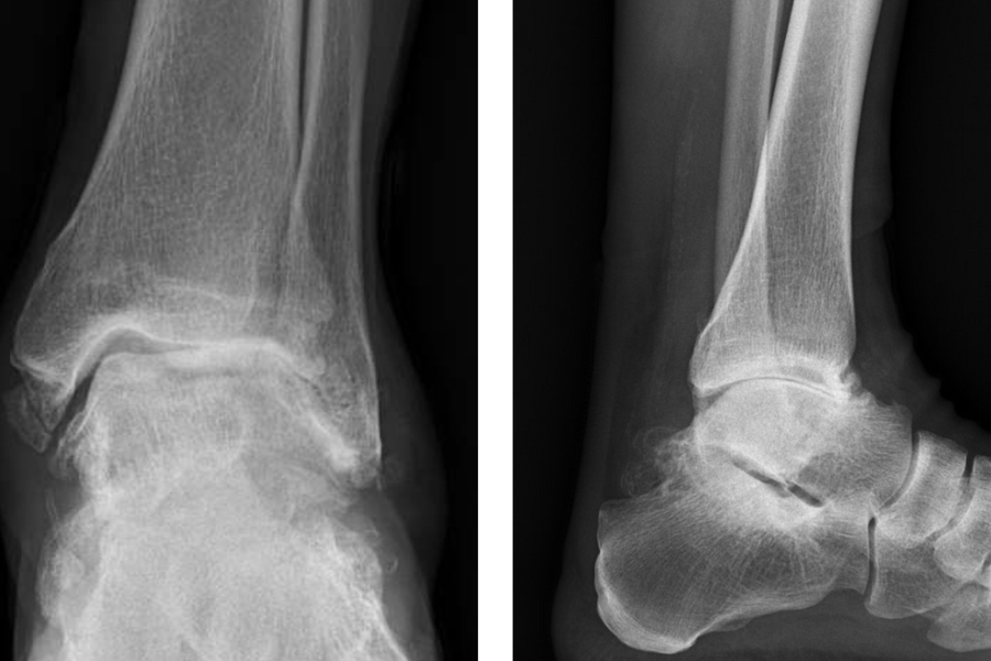 Pre-operative radiographs of the patient’s arthritic ankle.