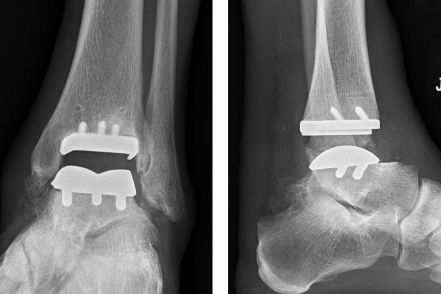 One-year post-operative radiographs of patient's ankle replacement by Schweitzer.