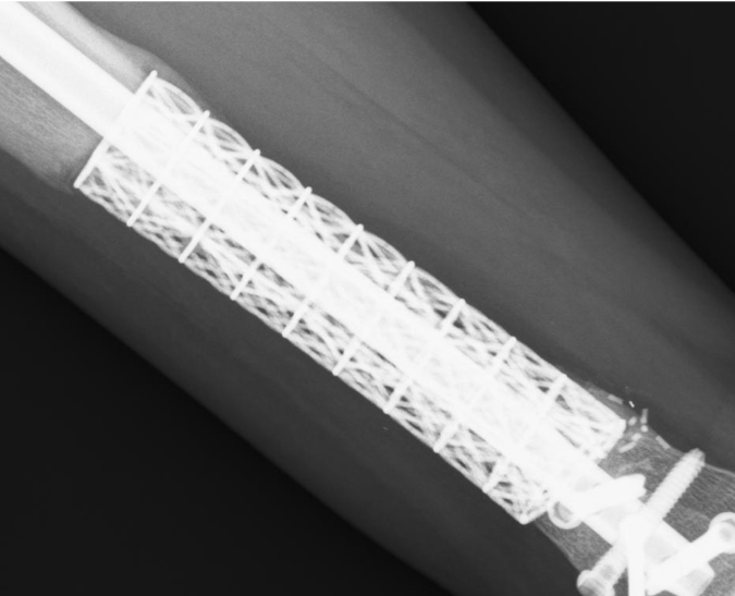 Patient's bone growth one year postoperative