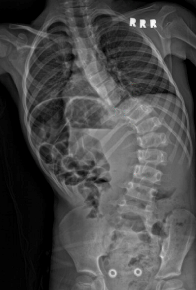 Early onset scoliosis patient spine radiograph before surgery