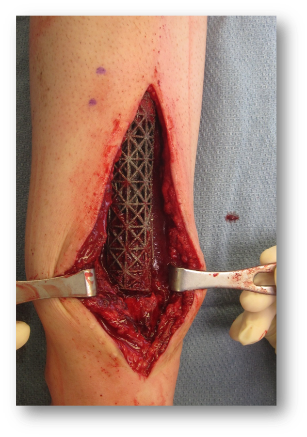 Intraoperative photo shows implant being positioned