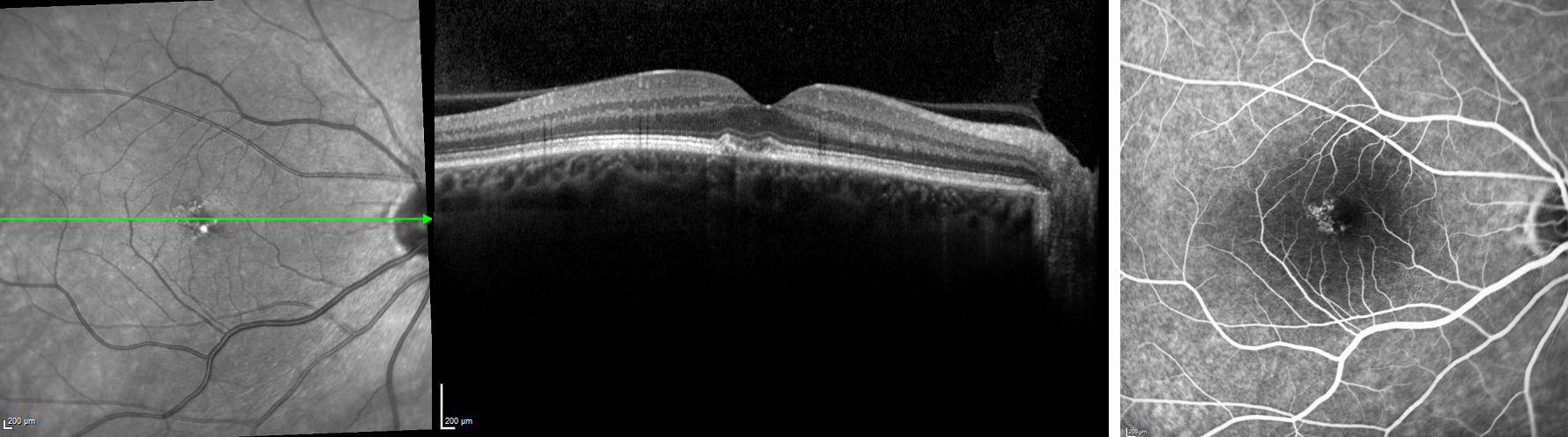 oct macular test