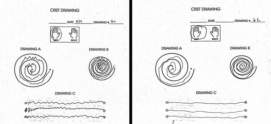 Before and after written test showing patient's improvement in handwriting