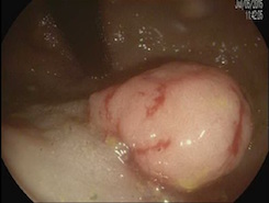 rectal adenocarcinoma