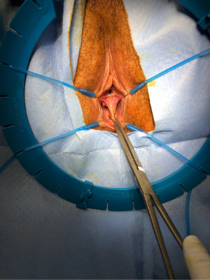 A vaginal septum shown in the OR. This condition can be difficult to see in a clinical office setting. 