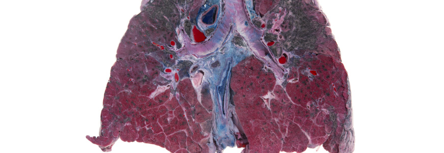 Gross specium of lung