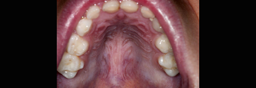image of a roof of a mouth