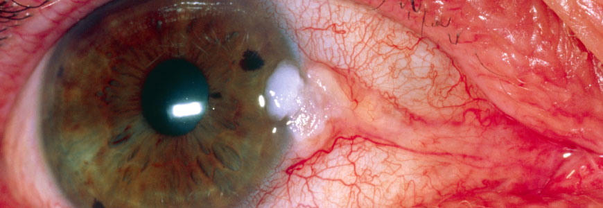 image of eye