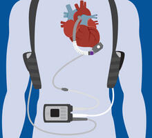 Ventricular Assist Science Advances, Helps More Patients