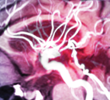 Unruptured Aneurysm Research and Tools for Patient Care