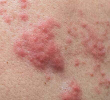 Patient Presents with Severe Urticaria, Related Psychological Distress