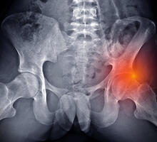 Imaging Innovations Improve Hip Impingement Surgery Outcomes