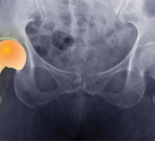 Augmented Reality Enhances Hip Replacement Outcomes