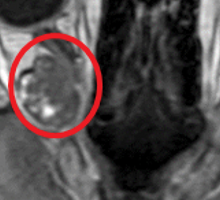 A Large Cavernoma Causing Unilateral Proptosis Compromises a Veteran’s Eyesight