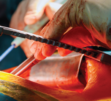 Duke Cardiothoracic Transplant Program Accepts the Most Complex Cases
