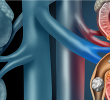 Complex Kidney Stone Program Expands
