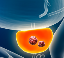 Over Two Decades of Prostate Cancer Care Build Expertise, Innovation