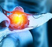 Integrated Team Expands Effective Pancreatic Cancer Treatment Options