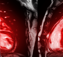 Precision Cardiomyopathy Improves Detection, Treatment