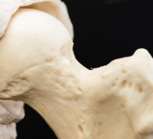 Early Intervention for Perthes Disease May Avoid Surgery