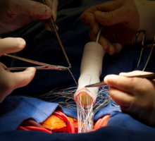 Duke Center for Aortic Disease Combines Expertise in Cardiothoracic and Vascular Surgery
