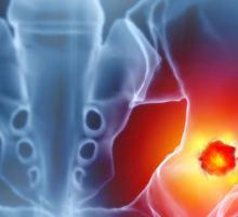 Chondrosarcoma Research Discovers Potential Treatment Pathways