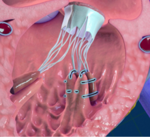 Duke Health Pioneers Two World-First Pediatric Heart Procedures