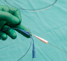 Catheter-Based Renal Denervation Treats Resistant Hypertension