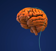 Multidisciplinary Team Develops Collaborative Program for Deep Brain Stimulation