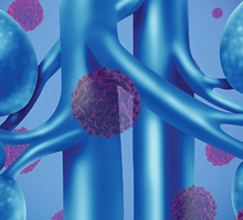 Collaborative Procedure to Treat Renal Carcinoma with Venous Involvement