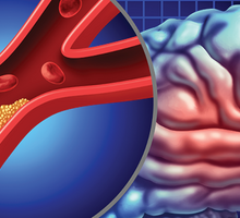 Innovative Procedures Improve Transcarotid Artery Revascularization