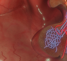 Pituitary Tumor Resection Restores Pediatric Patient’s Vision
