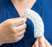 Physician-Modified Endografts Offer Help for Complex Aortic Aneurysm Anatomy