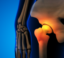 Cutting-Edge Technologies Enhance Joint Replacement