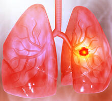 Autotransplantation a New Option To Treat Complex Lung Tumors