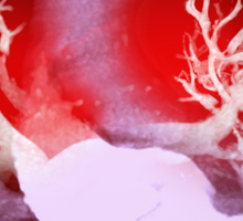 Pulmonary Embolism Sequelae Require Advanced Treatment