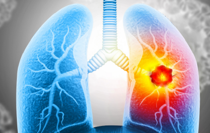 Duke Offers Expertise in New Immune Therapy for Advanced Small Cell Lung Cancer