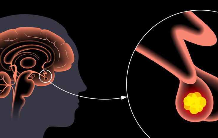 Multiple Comorbid Conditions Vanish After Pituitary Tumors Resected
