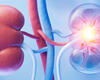Duke Living Donor Kidney Transplant Program Continues to Expand