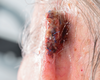 New Focus on Improving Melanoma Therapies for Older Patients