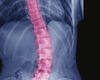 Innovations in Scoliosis Treatment