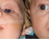 Orthopedic Device Reduces Number of Surgeries Needed in Cleft Lip and Cleft Palate