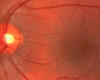 Duke Emergency Services for Eye Stroke Have Regional Reach