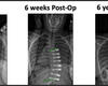 Scoliosis Patient Was First to Receive Innovative Procedure in North Carolina 