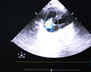 Device Offers Minimally Invasive Surgical Therapy for Tricuspid Regurgitation